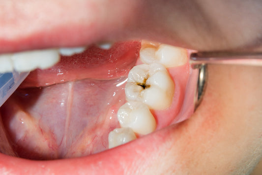 Why Dry Mouth Increases Cavity Risk